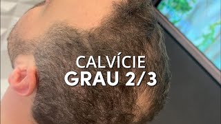 CALVÍCIE GRAU 2/3 - FOCO NO VISAGISMO