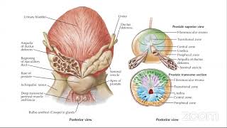 Seminar onBenign Prostatic Hyperplasia