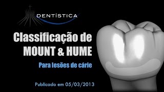 Classificação de MOUNT & HUME para lesões de cárie