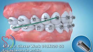 منظم کردن دندان توسط اورتودانسی Orthodontics