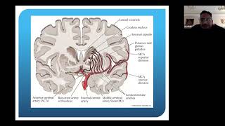 Role of interventional radiology in treating neurological strokes