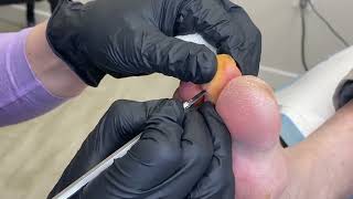 Watch Here: Podiatrist Performs a Flexor Tenotomy Procedure