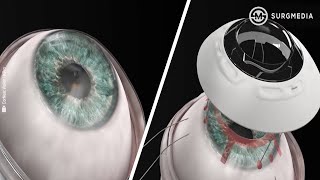 Synthetic Cornea Implanted in First Patient