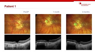 Subretinal Bionic Prosthesis for Geographic Atrophy in AMD - First implantation in Germany