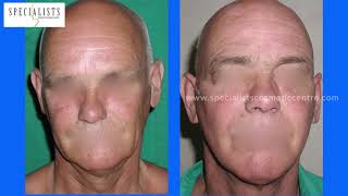 Face Lift Surgery in Kochi | Cosmetic Surgery in Kerala | Plastic and Cosmetic Surgeon in India