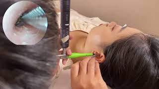 curved ear canal  visual ear cleaning, stress relief