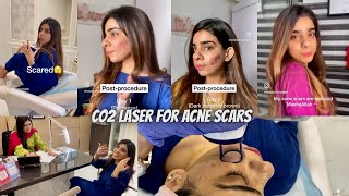 BURNED MY SKIN TO GET RID OF ACNE SCARS😳SCARY!! 😱 | what causes acne, treatments, do’s & don’ts