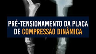 Pré-tensionamento da placa de compressão dinâmica