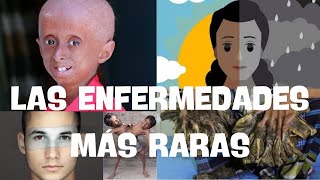 Las 5 enfermedades más RARAS del mundo ¿Las conocías?