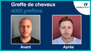 Greffe de cheveux en Hongrie : "A 22 ans, je commençais à perdre mes cheveux !"