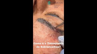 Como é o Transplante de Sobrancelhas?