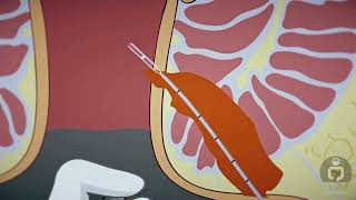 FİLaC (Fistula Tract Laser Closure ) Animation