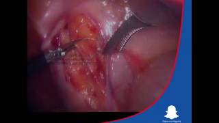 Laparoscopic Varicocelectomy Dr. Ali Mehdi Zadeh Consultant Urologist in Kuwait