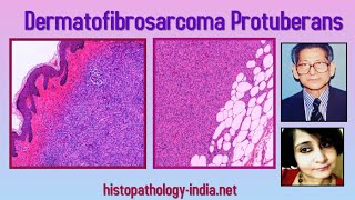 Pathology of Dermatofibrosarcoma Protuberans by Dr Sampurna Roy MD ( dermatopathology , dermpath )