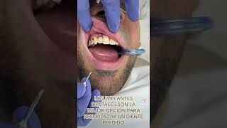 implante dental/ carga inmediata  #dentist #smile #implantesdentarios