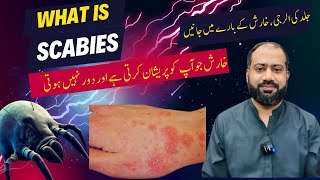 Scabies in Urdu | Kharish Ka ilaj | Skin allergy ka ilaj | Skin itching