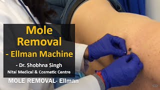 Mole Removal Treatment using Ellman Machine | Nitai Medical & Cosmetic Centre