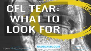 CALCANEOFIBULAR LIGAMENT TEAR: WHAT'S NORMAL AND WHAT TO LOOK FOR IN A TEAR