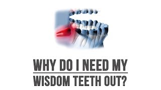 Specialized training makes choosing an oral surgeon for wisdom tooth removal, the best choice!