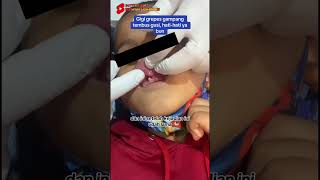 GIGI ANAK GREPES GAMPANG TEMBUS GUSI 🫣 #gigianak #gigianakgrepestembusgusi #ulkusdikubitus #dentist