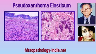 Pathology of Pseudoxanthoma Elasticum - Dr Sampurna Roy MD (dermpath, dermatopathology)