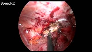 LAPAROSCOPİC LOOP İLEOSTOMY-By Murat AKBABA,Md