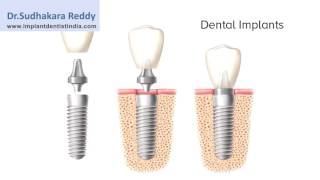 Dental Implant Procedures In  Bangalore | Best Implant Center In India