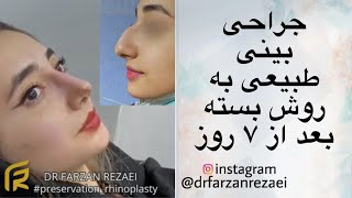 نمونه ای از جراحی بینی طبیعی به کم تهاجمی