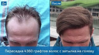 Эффект от пересадки волос спустя года! Пересадка 4360 графтов методом FUE в Турции