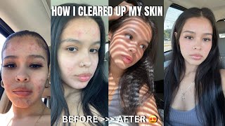 HOW I CLEARED MY ACNE IN LESS THAN 3 MONTHS