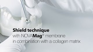 Shield technique with NOVAMag® membrane in combination with a collagen matrix