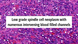 Pathology of Kaposi Sarcoma by Dr Sampurna Roy MD