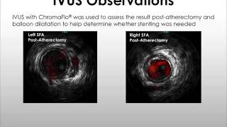 Percutaneous Revascularization of Left and Right Superficial Femoral Arteries (SFA)