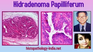 Pathology of Hidradenoma Papilliferum by Dr Sampurna Roy MD ( dermpath , dermatopathology)