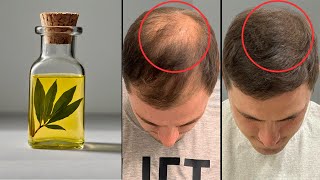 Koreanische Ärzte haben mit diesem Rezept meine Glatze geheilt! Haare wachsen wie verrückt!