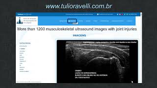 Sternoclavicular dislocation monitored by ultrasound