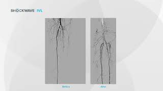 Dr. Armstrong CLI Case: PMH of Diabetes & CKD – Nonhealing Wound of Plantar Surface of 4th Digit