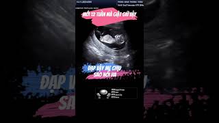 Mới 12 tuần mà đạp như  20 tuần vậy #sieuamthai#ultrasound#mebau#pregnancy#baby#beyeu#sieuam#shorts