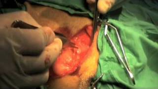 Hernia perineal