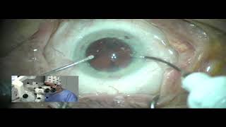 Cataract surgery using Mydrane