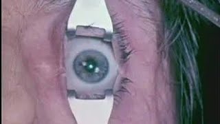 Real autopsy. Enucleation - removal of the eye. 1970 surgical teaching film for pathologists.