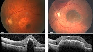 Aderhautpatch zur Behandlung der feuchten AMD mit Pigmentepitheleinriss (RIP) – Prof. Peter Szurman