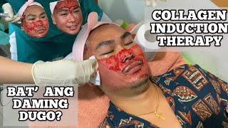 MICRONEEDLING TREATMENT PHILIPPINES | AFTERCARE | BEFORE AND AFTER  | GLUTAPEEL