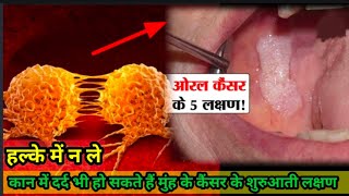 munh ke cancer ke shuruwaati lakshann | oral cancer symptoms in hindi | Mouth ke cancer treatment.