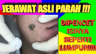 jerawat parah muncrat | jerawat batu | mengobati jerawat | pencet jerawat