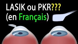 LASIK ou PKR? Comparaison des procédures, animation