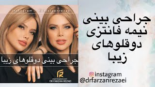 ‏‎⭐️جراحی بینی به روش مُدرن کم تهاجمی⭐️