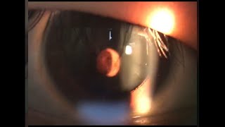 Slitlamp Examination of the Cyst