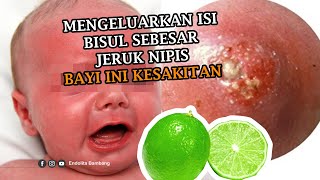 Pencet Bisul sebesar jeruk Nipis, bayi ini kesakitan | Reaction