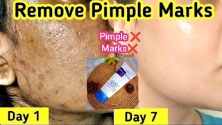 Mistine acne clear face wash Review | Acne treatment at home | how to get rid of acne and acne scars